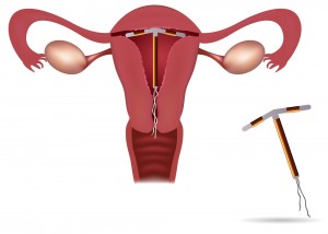 IUD Credit: www.sogamds.com