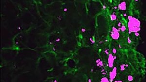 Reprogrammed stem cells (green) chase down and kill glioblastoma cells (pink) Credit: UNC Eshelman School of Pharmacy