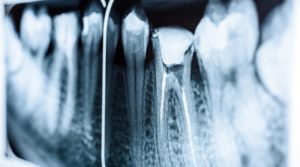 tooth x-ray