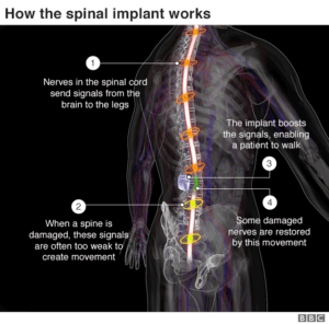 Spinal implant helps three paralysed men walk again - Schwartzreport